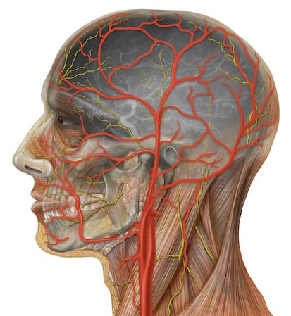Microplastics Found in Stroke Patients' Arteries at 51× the Normal Level